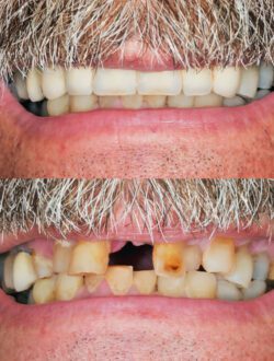 Why Do I Need to Replace Missing Teeth?