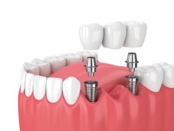 tooth replacement solutions in Severna Park Maryland