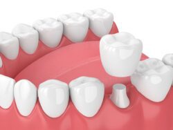cover a damaged tooth with a dental crown