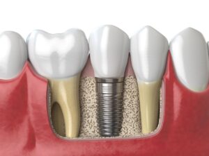 Dental Implant Failure FAQs